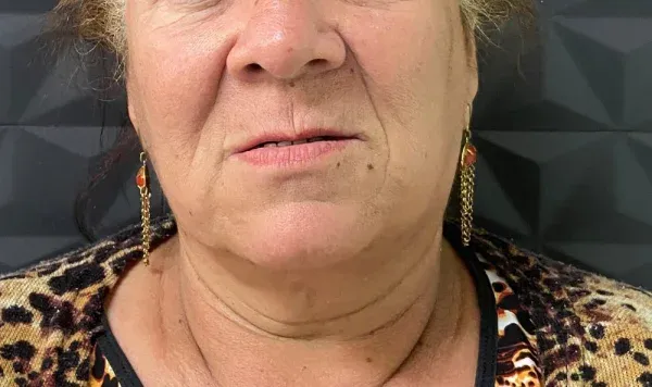 Antes e depois 1 de implante dentário de carga imediata na Odontologia Agrega, em Itu/SP