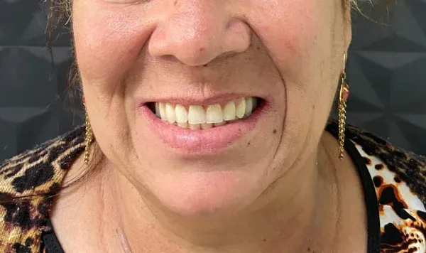 Antes e depois 2 de implante dentário de carga imediata na Odontologia Agrega, em Itu/SP