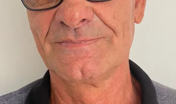 Antes e depois 3 de implante dentário de carga imediata na Odontologia Agrega, em Itu/SP