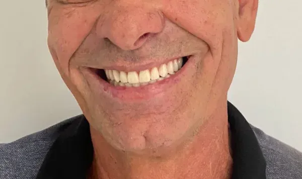 Antes e depois 4 de implante dentário de carga imediata na Odontologia Agrega, em Itu/SP