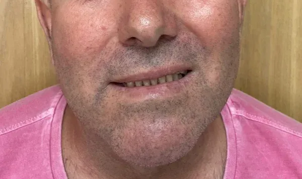 Antes e depois 5 de implante dentário de carga imediata na Odontologia Agrega, em Itu/SP