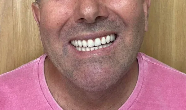 Antes e depois 6 de implante dentário de carga imediata na Odontologia Agrega, em Itu/SP