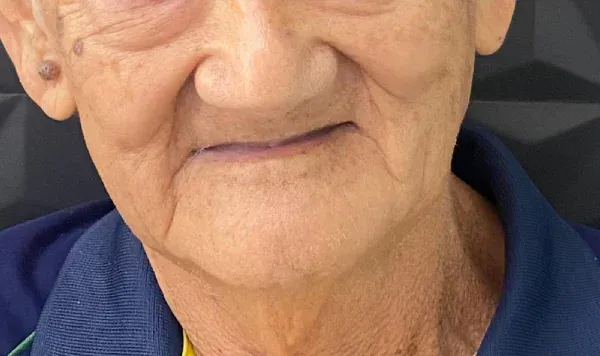 Antes e depois 7 de implante dentário de carga imediata na Odontologia Agrega, em Itu/SP