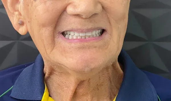 Antes e depois 8 de implante dentário de carga imediata na Odontologia Agrega, em Itu/SP