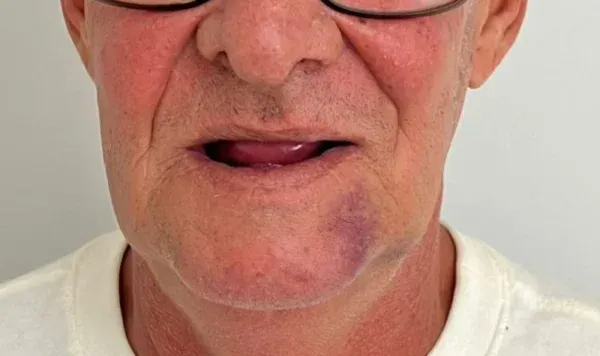 Antes e depois 9 de implante dentário de carga imediata na Odontologia Agrega, em Itu/SP
