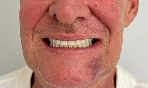 Antes e depois 10 de implante dentário de carga imediata na Odontologia Agrega, em Itu/SP